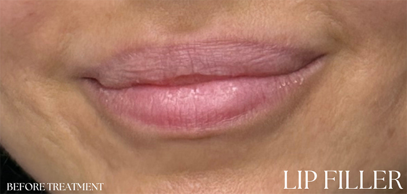 Lip Fillers Before & After Image