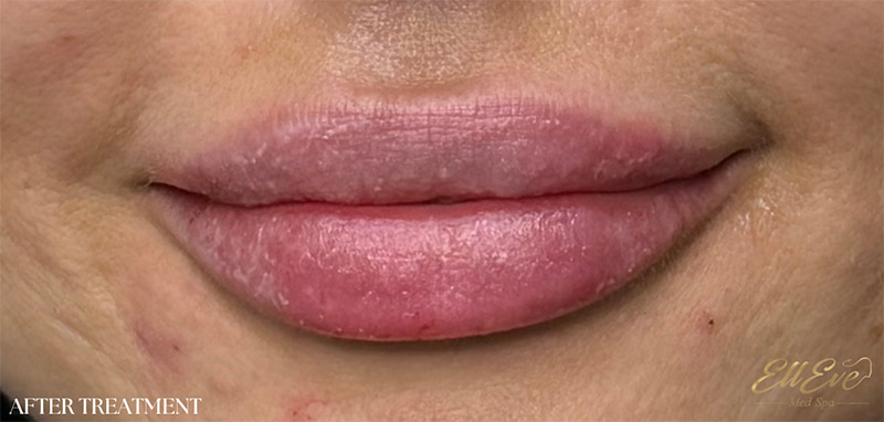 Lip Fillers Before & After Image