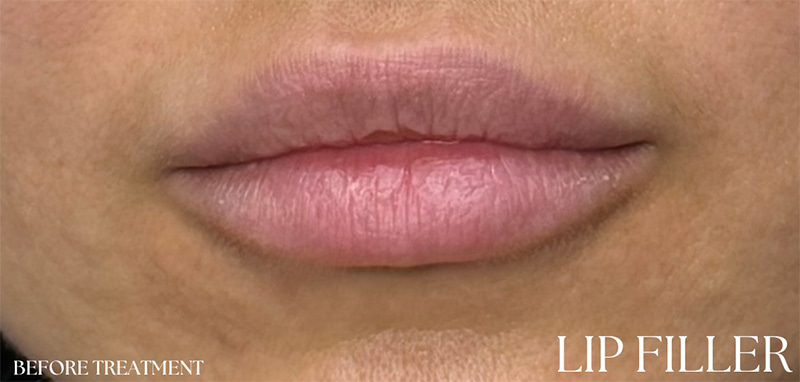 Lip Fillers Before & After Image