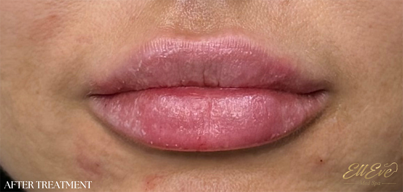 Lip Fillers Before & After Image