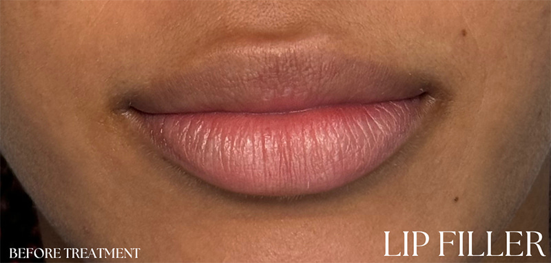 Lip Fillers Before & After Image