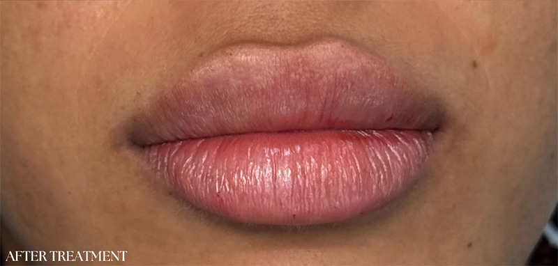 Lip Fillers Before & After Image