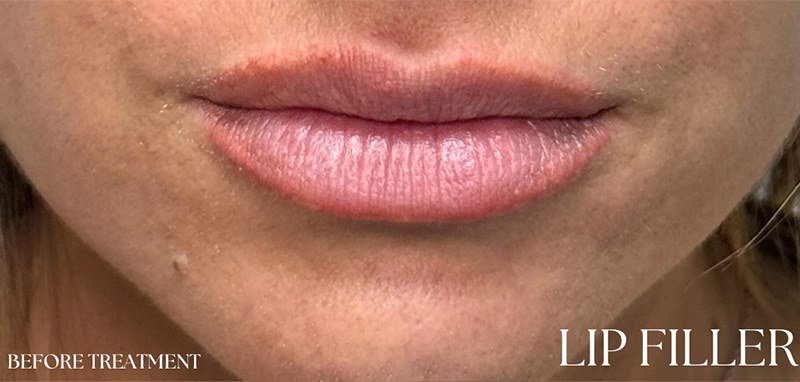 Lip Fillers Before & After Image