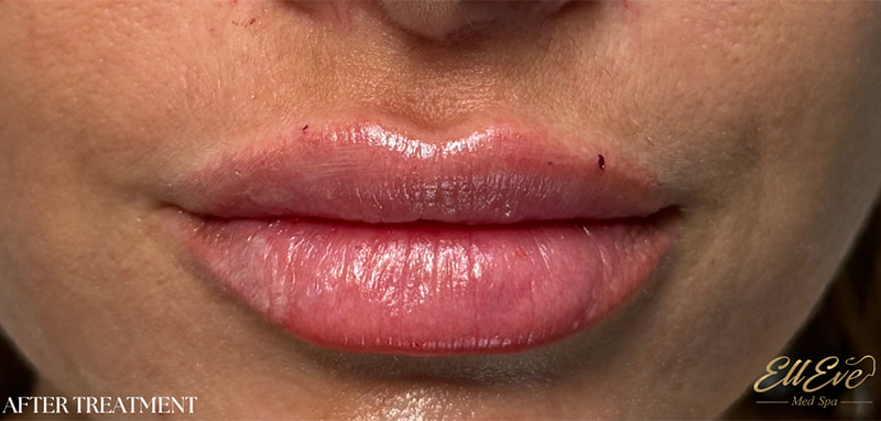 Lip Fillers Before & After Image