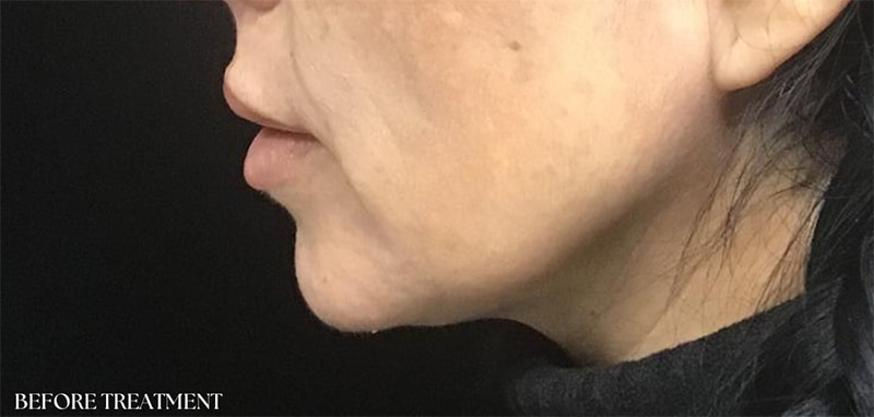 RF Microneedling Before & After Image