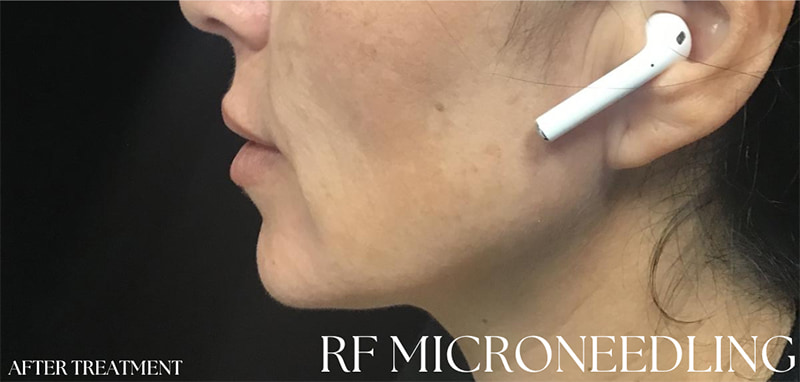 RF Microneedling Before & After Image