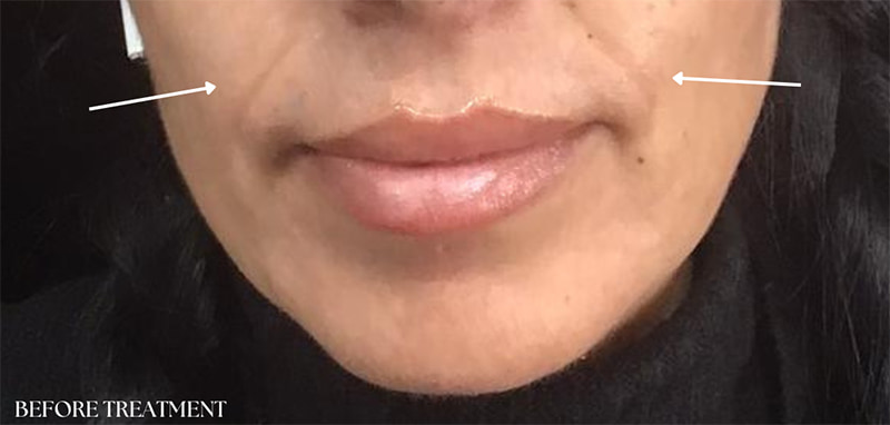 RF Microneedling Before & After Image