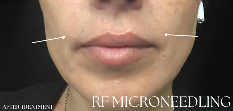 RF Microneedling Before & After Image